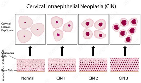 Cervical dysplasia stages and pap smear test Stock Illustration | Adobe Stock