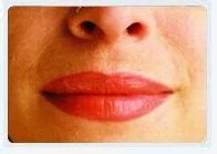 Lip Augmentation/ Reduction, Aesthetic Surgery, Cosmetic Surgery ...