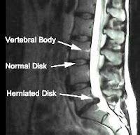 CT/MRI: Bulging Discs in Lumbar Spine