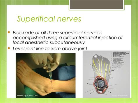 Ultrasound Guided Peripheral Nerve Blocks