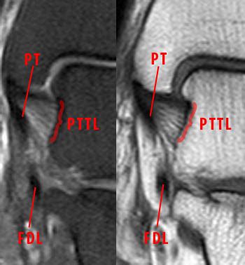 MRI Musculo-Skeletal Section: Deltoid ligament injury.