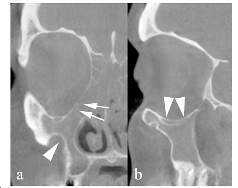 Uncinate process collapse. CBCT reformations on the coronal (a) and ...