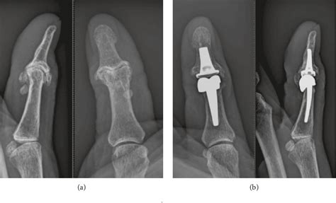 Figure 1 from Thumb Interphalangeal Joint Replacement as an Alternative to Joint Fusion ...