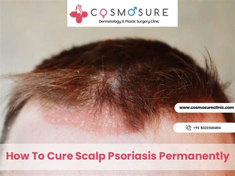 Minor Scalp Psoriasis