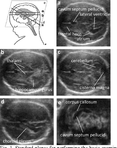 Figure 1 from Automatic measurement of fetal head structures using ultrasound | Semantic Scholar