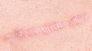 Skin Care Tips From Dermatologist: Koebner Phenomenon in Psoriasis