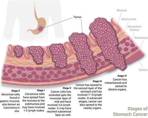 Stages of Stomach Cancer and their relevance to prognosis