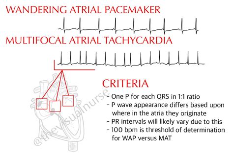 WAP vs. MAT on ECG: What’s the difference? — The Visual Nurse