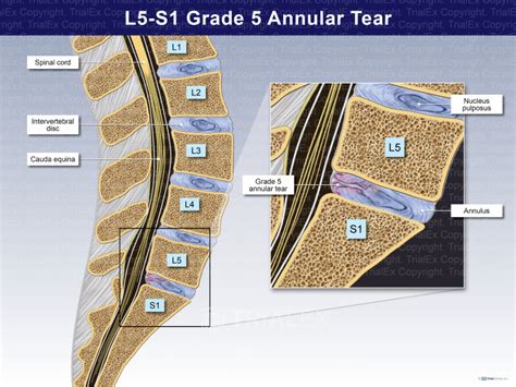 L5 - S1 Grade 5 Annular Tear - TrialQuest Inc.