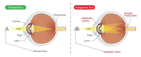 Treatment for Astigmatism in Derry & Surrounding Areas