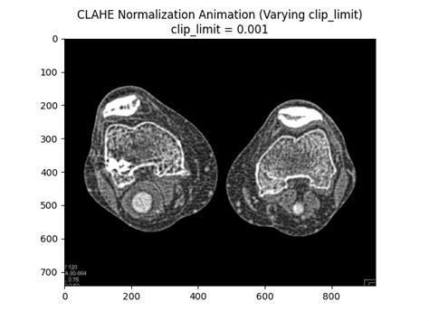 CT Scan Pre-Processing to Enhance PAA Segmentation Accuracy