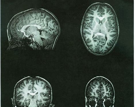 Can an MRI Detect Dementia? - ReaDementia