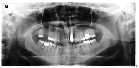 Images of orthopantomograms performed on 22nd November 2011 (a) and... | Download Scientific Diagram