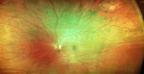 Optomap Retinal Eye Exam | | Springfield & Wayne NJ | Garden State Eye Group