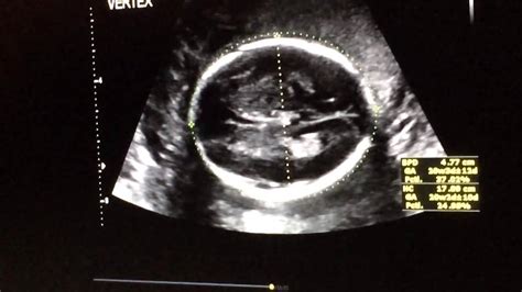 20 week anatomy ultrasound part 4 - YouTube