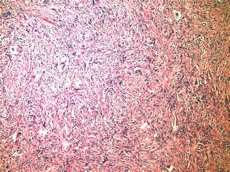 Malignant Fibrous Histiocytoma (MFH) of Bone