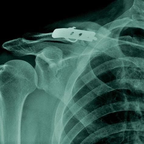 Clavicle Fracture | Broken Collar Bone | Shoulder Specialist | South Windsor, Rocky Hill ...