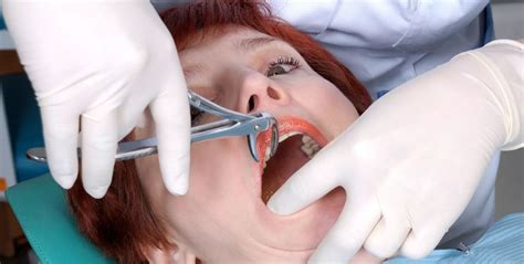 broken tooth extraction procedure Archives - Elite Dental Care