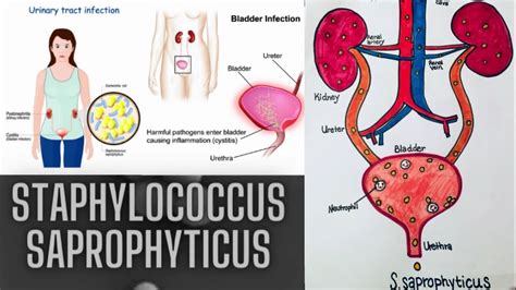 staphylococcus microbiology lecture ||staphylococcus saprophyticus ...