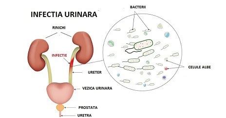 Da din cap doc Aveți nevoie de infectie urinara barbati simptome si tratament - proprint.ro