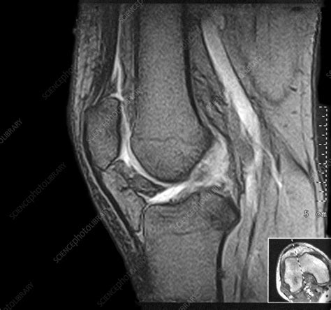 Knee joint, MRI scan - Stock Image - C002/1301 - Science Photo Library