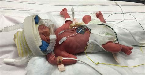 The story of our preemie in the NICU of Northside Hospital