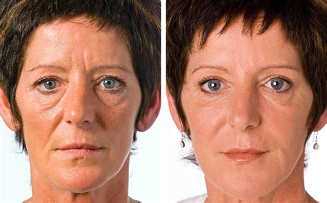 Non-surgical Facelift | Hill Street Clinic