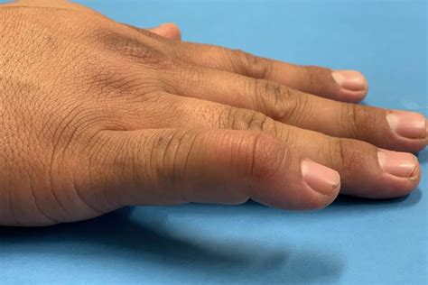 Mallet Finger – Hand Therapy Group