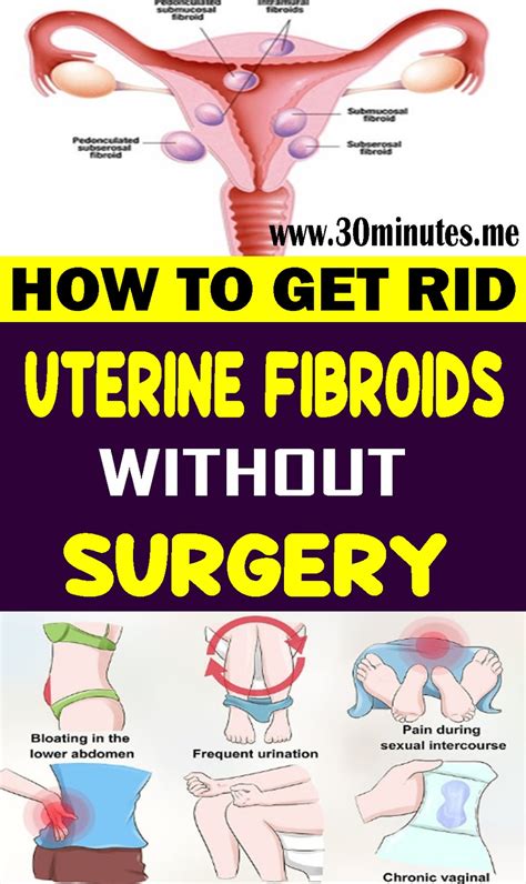 How to Get Rid of Uterine Fibroids without Surgery - HEALTH and WELLNESS