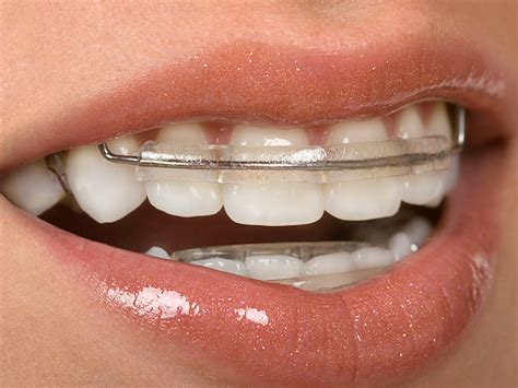 Can You Straighten Your Teeth Without Braces? - Burlingame Smile Studio