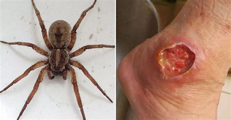 The worst spider bite pictures including the Brown Recluse and Black ...