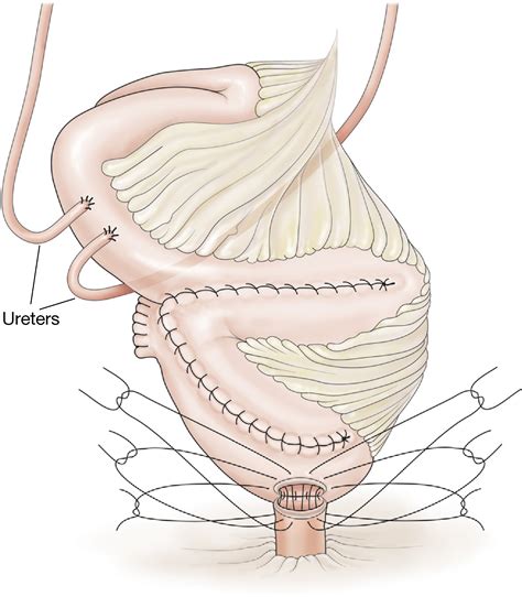 Bladder cancer - Surgery - Oxford International Edition