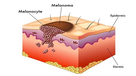 What Is Melanoma? | Skin Cancer - YouTube