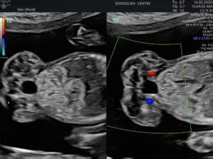 Single umbilical artery type-II: don’t miss this avatar - ScholarMD