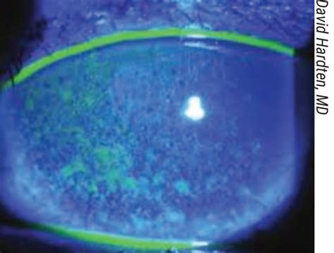 Corneal Staining Dry Eye