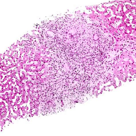 Tuberculosis Histology