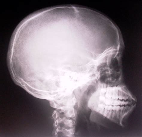 Skull Xray Free Photo Download | FreeImages