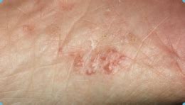 Types of Psoriasis |psoriasisSPEAKS