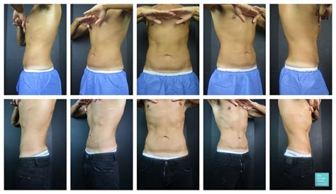 CoolSculpting for Men upper, lower abdomen before after results, Fat Freezing Male flanks