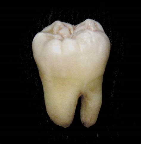 Molar (tooth) - Wikipedia
