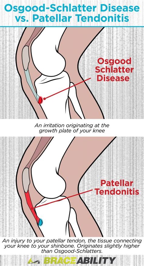 Osgood Schlatter Disease in Adults: Treatment for Knee Pain