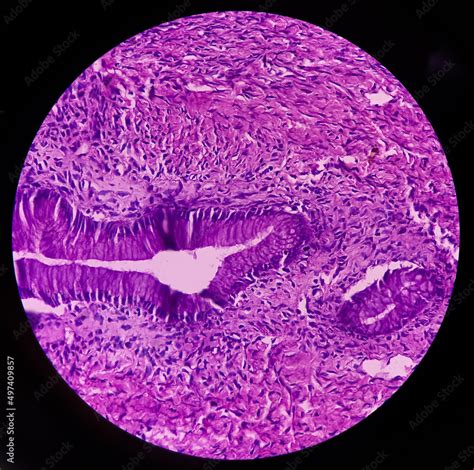 Ovarian cyst(biopsy): Mucinous cystadenoma, a benign tumor of ovary, ovarian cyst wall show ...