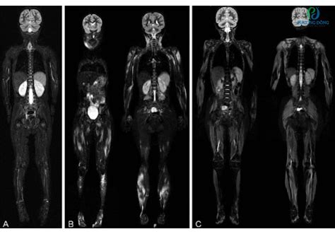 Chụp MRI toàn thân là gì? Phát hiện ung thư nhờ chụp MRI toàn thân