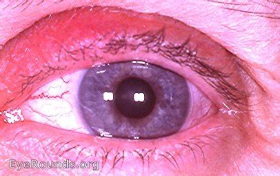 Congenital ectropion uveae. EyeRounds.org: Online Ophthalmic Atlas