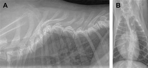 Figure 6 from Kyphosis and Kyphoscoliosis Associated with Congenital ...