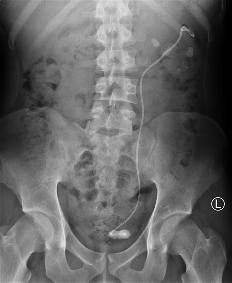 How To Deal With A Kidney Stent - Percutaneous Nephrolithotomy Pcnl My Kidney Stone Boston ...