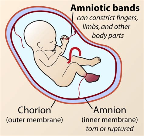 Fetal membrane layers, Chorion, Amnion, Yolk sac and umbilical cord ...