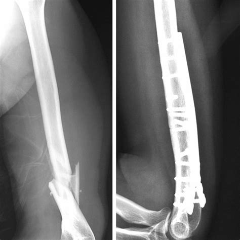 Ball Thrower S Fracture Of The Humerus Associated With Radial Nerve Palsy | My XXX Hot Girl
