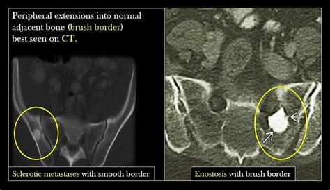 DD between Enostosis(bone island) and sclerotic metastasis. | Border, Radiology, Bones