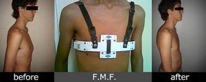 Treatment For Pectus Carinatum - Pectus Carinatum